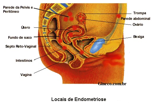 endometriose_local.jpg